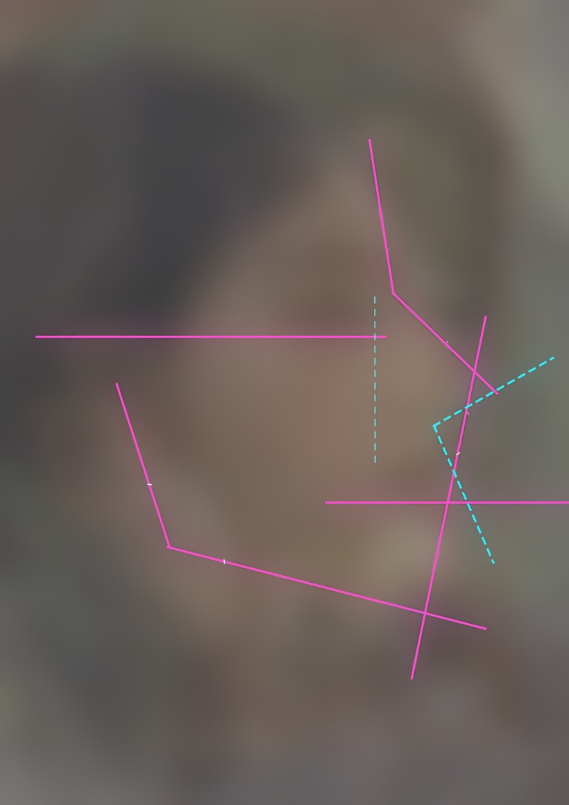 Profile overlay study: jaw and nose angle lines over a face blurred beyond recognition